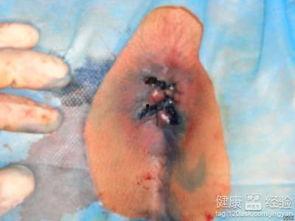 痔疮手术可以吃瓜嘛,西瓜,可以吗?