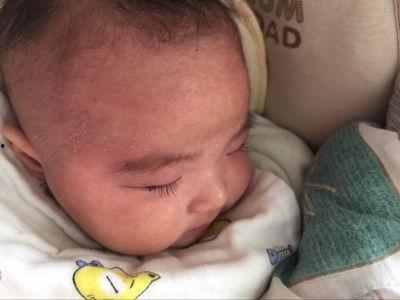 孩子湿疹吃瓜能行吗,西瓜，真的能缓解症状吗？